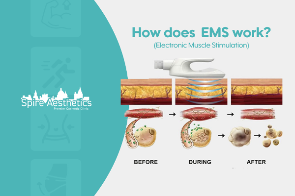 EMS treatment for post pregnancy weight loss treatment Westcliff on Sea