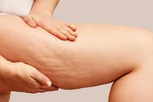Image of woman showing leg with cellulite Westcliff on Sea