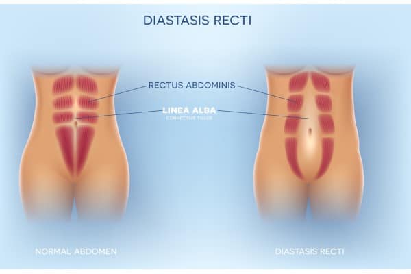 How Does Non-Surgical Treatment Help With Loose Skin, Weak Abdominal Muscles and Post-Pregnancy Changes Westcliff on Sea?