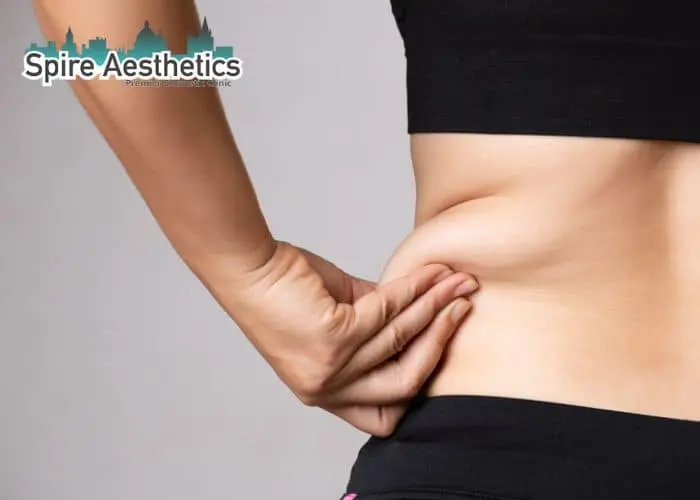 Image of woman pinching fat on their hips Westcliff on Sea. Fat Freezing treatment