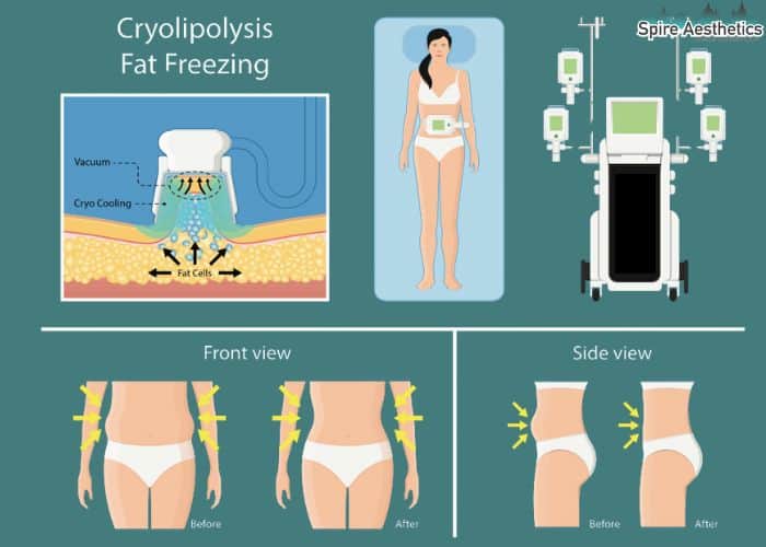 Image of diet and fat freezing combined for best results for Spire Aesthetics Westcliff on Sea