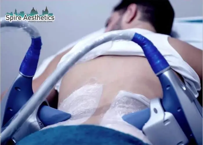 Man having fat freezing treatment done on love handles before a competitions Westcliff on Sea to create a sculpted look.