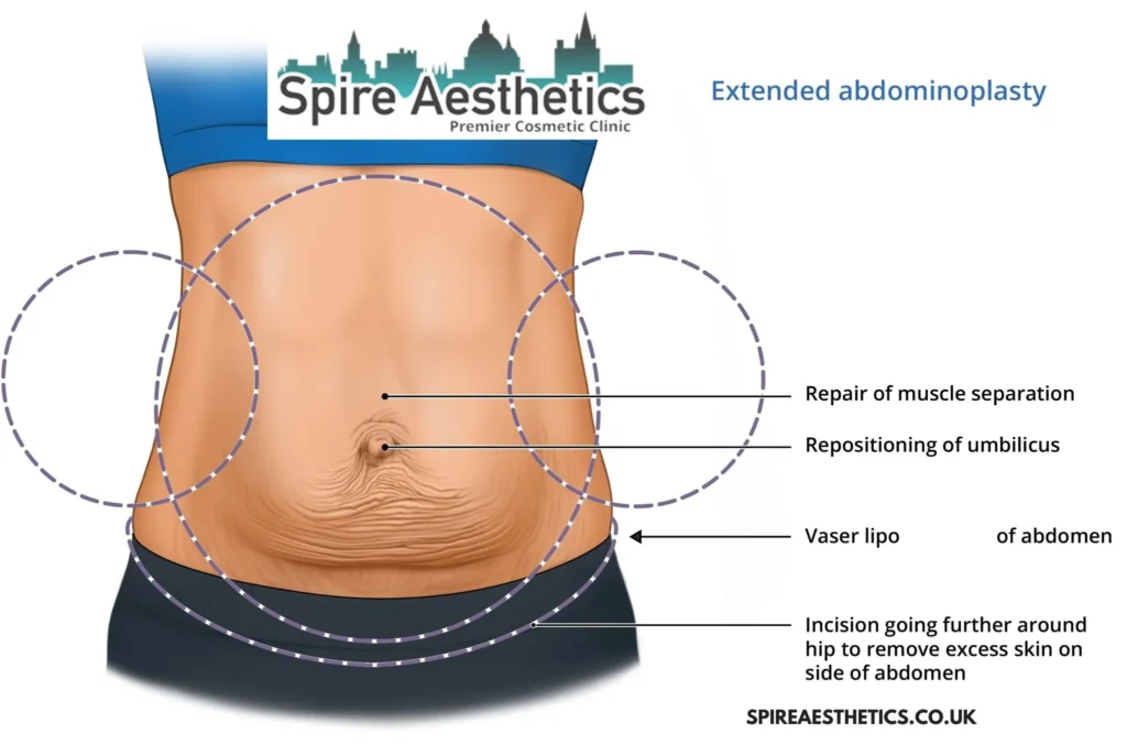 Understanding Loose Skin After Gastric Band Westcliff on Sea Surgery and HIFU Treatment