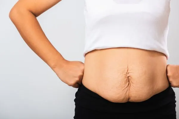 Image of a woman's stomach after weight loss with sagging skin following a gastric band Westcliff on Sea