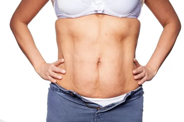 sagging skin on woman's stomach after weight loss injections Westcliff on Sea