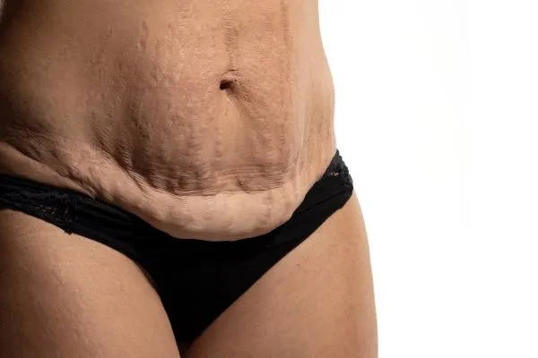 Image of womans stomach after weight loss injections Westcliff on Sea showing saggy skin