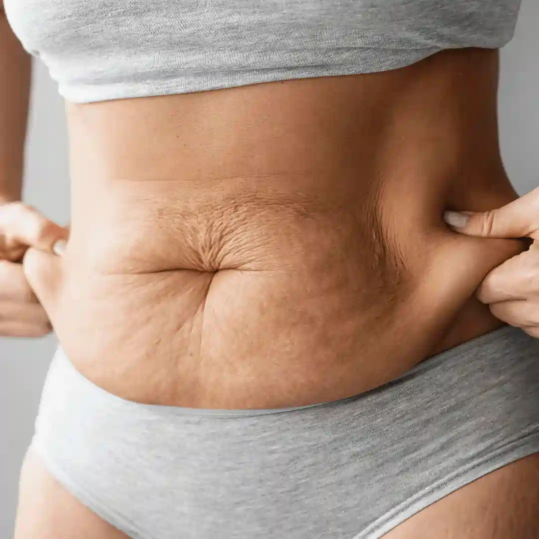 Is It Normal to Have Loose Skin After Pregnancy Westcliff on Sea?