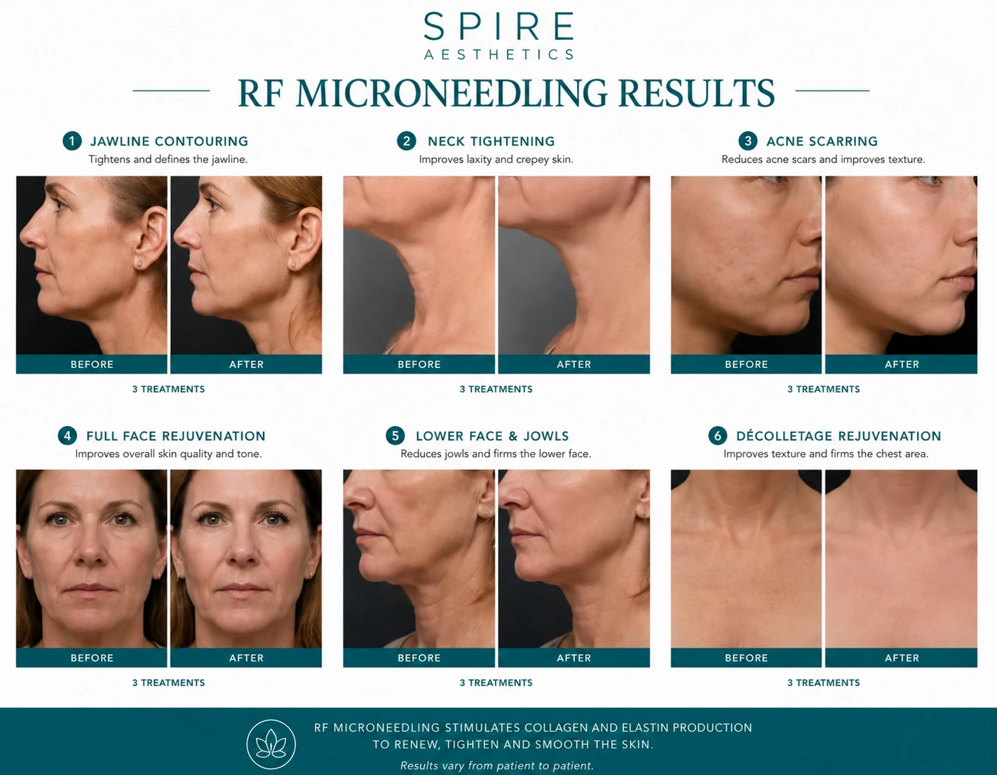 RF Microneedling Skin tightening Westcliff on Sea results