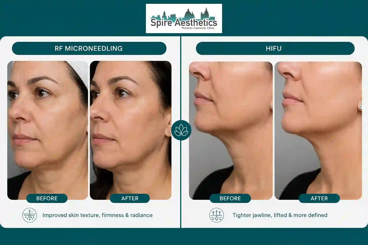 Can RF Microneedling and HIFU Be Combined Westcliff on Sea?