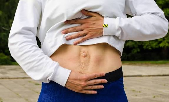 When Could Diastasis Recti Be the Missing Piece of the Puzzle Westcliff on Sea?
