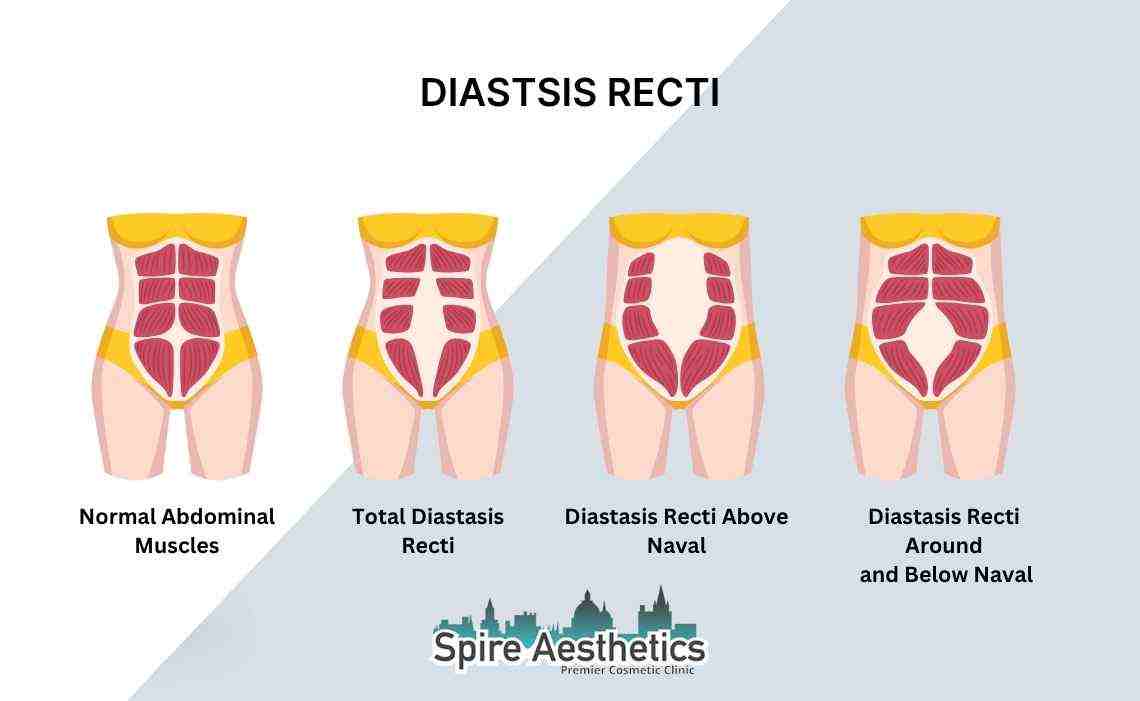 Is Non-Surgical Diastasis Recti Treatment Right for You? Common Concerns Answered Westcliff on Sea